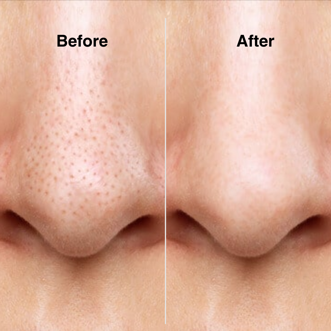 Glow Hydro Facial