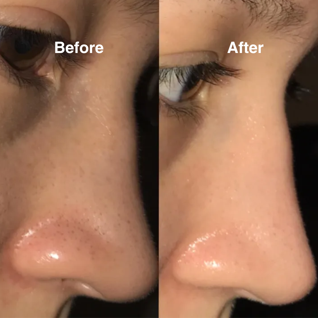 Glow Hydro Facial